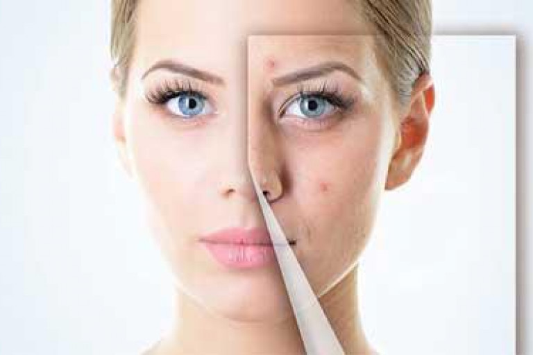 معنی جوش و آکنه در هر قسمت از صورت (1)