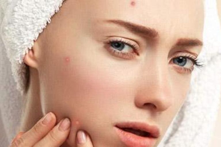 معنی جوش و آکنه در هر قسمت از صورت (2) 